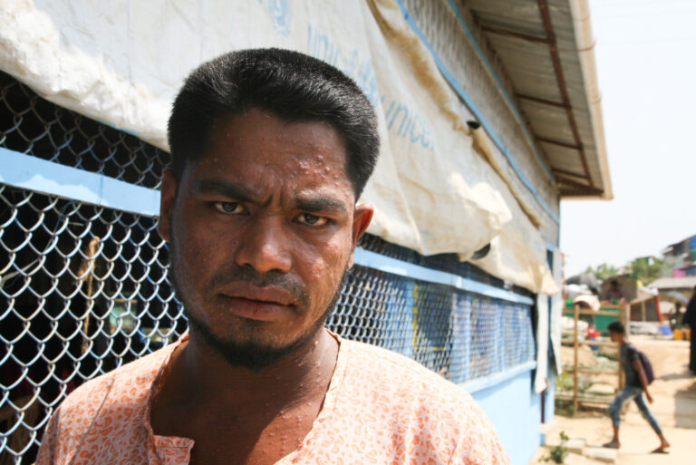 Silent Outbreak: Chickenpox surge exposes systemic vulnerabilities in Rohingya camps